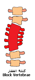 Scoliosis Scoliosis (11).gif